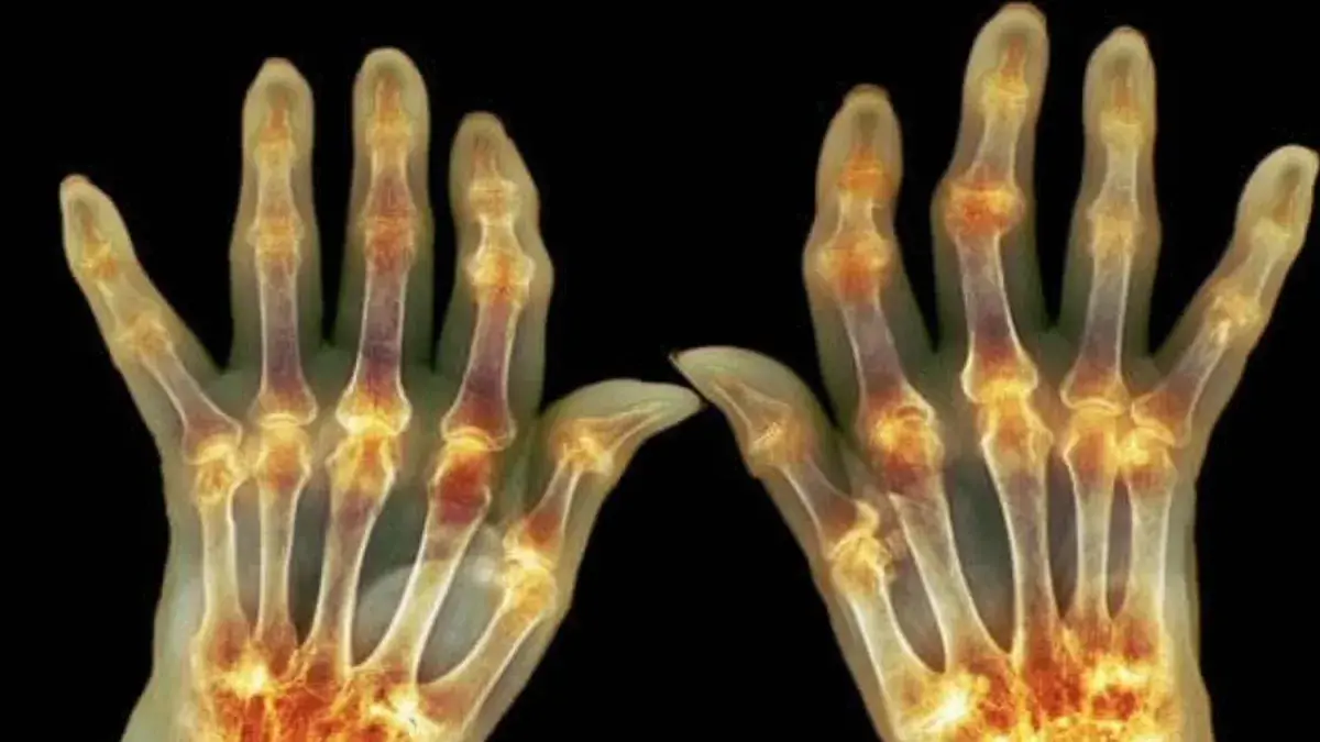 AI image of arthritis inflammation on joints in a pair of hands