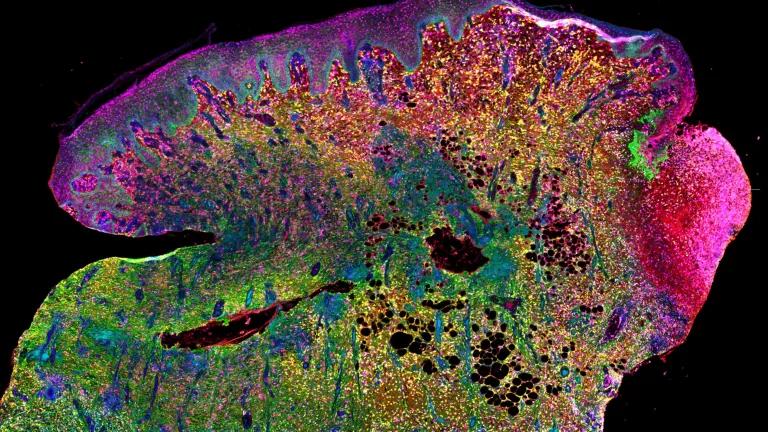 Immunofluorescence image of a diabetic foot ulcer.