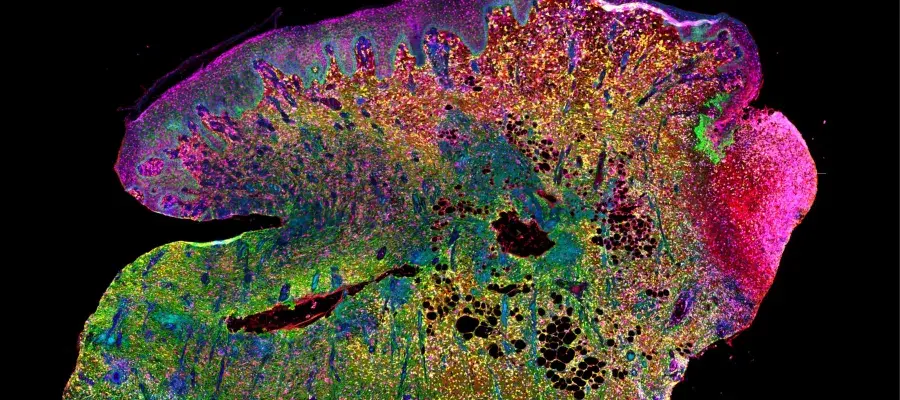 Immunofluorescence image of a diabetic foot ulcer