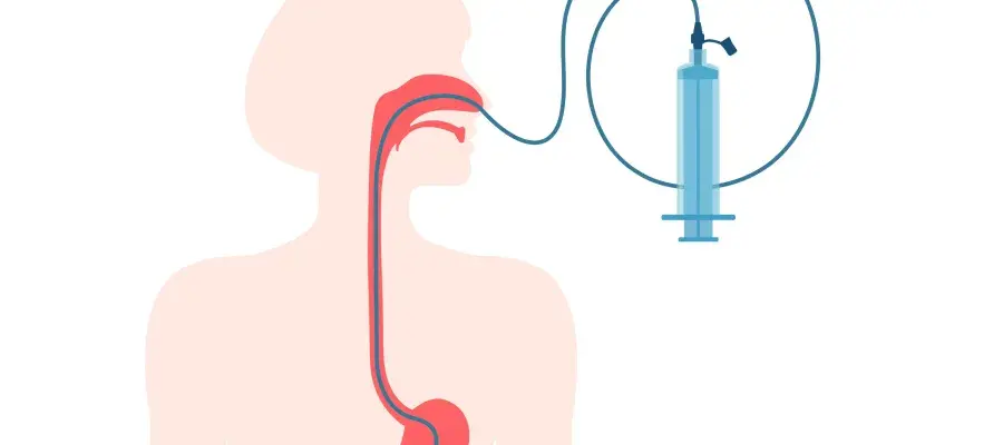 infographic of nasal gastric tube in person