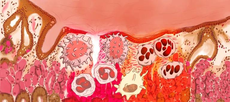 Tissue transect showing normal, damaged, healing and scarring with various cells - all in shades of red.