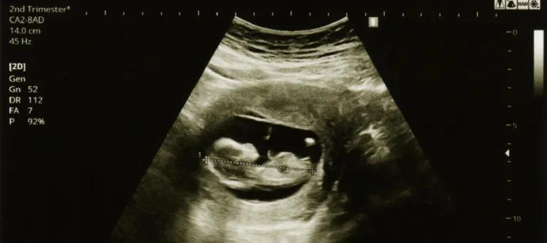 Ultrasound scan of a 3 month old baby