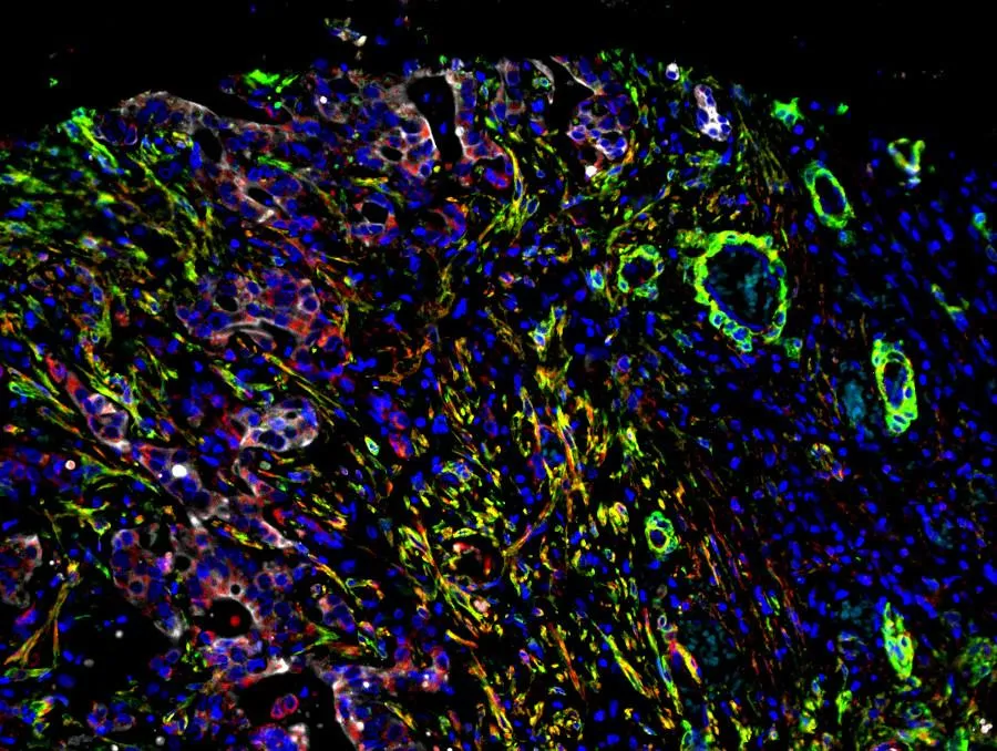 Human bile duct cancer containing tumour cells, cancer associated fibroblasts, and Fn14 receptors