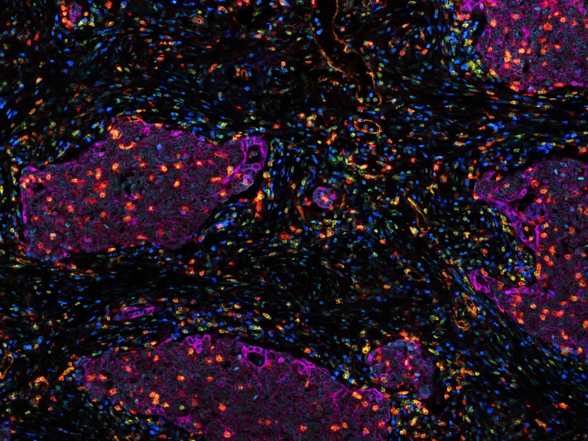 Clusters of lung cancer cells, known as the tumour nests (purple), infiltrated by cytotoxic T cells (orange) - Credit Lilian Koppensteiner
