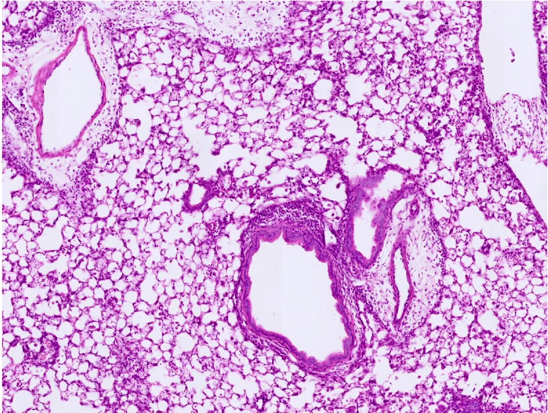 Histology image of inflamed lung tissue
