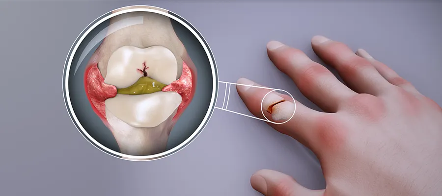 Hand cross-section showing inflamed knuckle joint seen in rheumatoid arthritis.