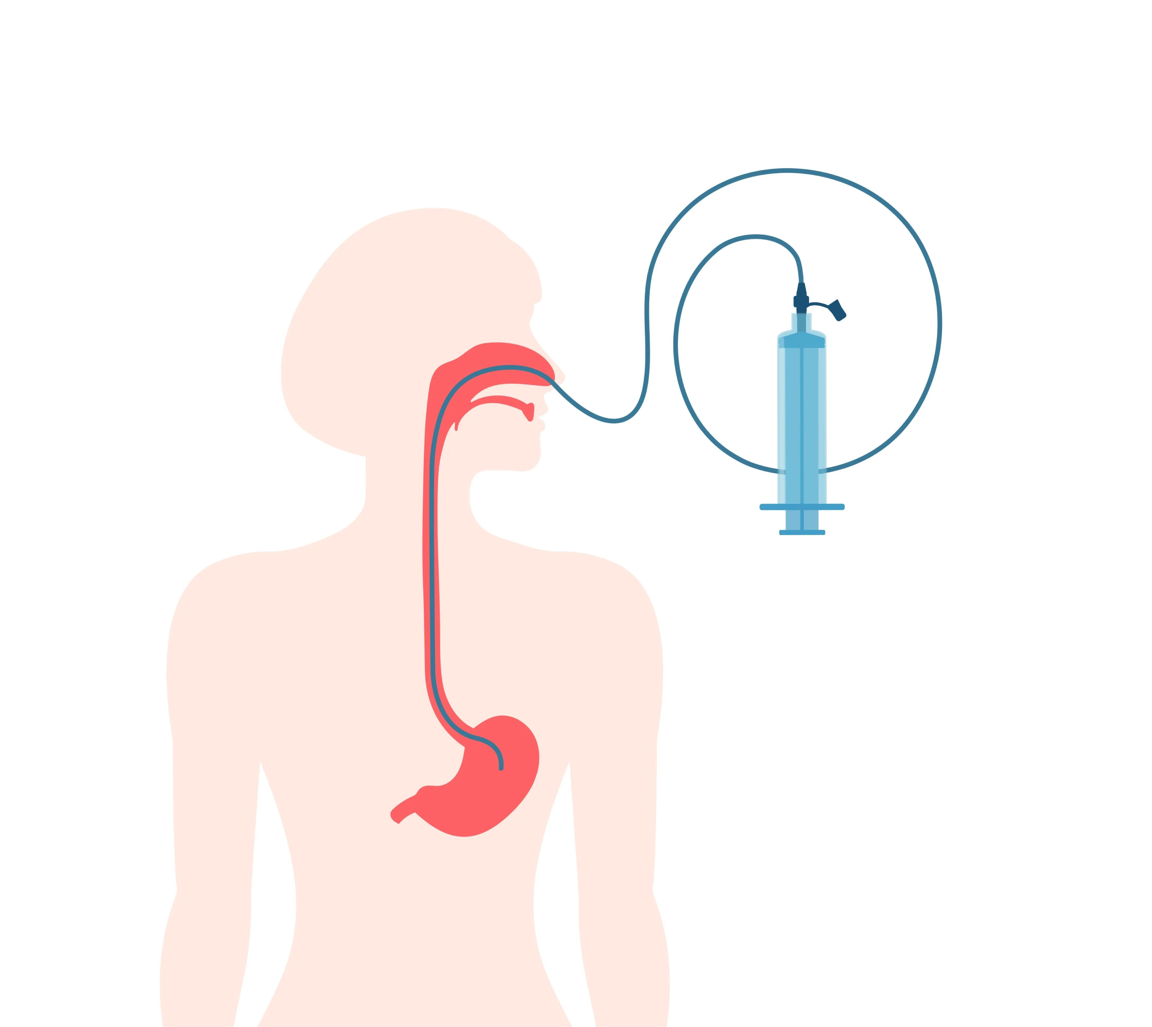 infographic of nasal gastric tube in person