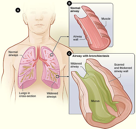 A cartoon showing the difference between an airway with and without bronchiectasis