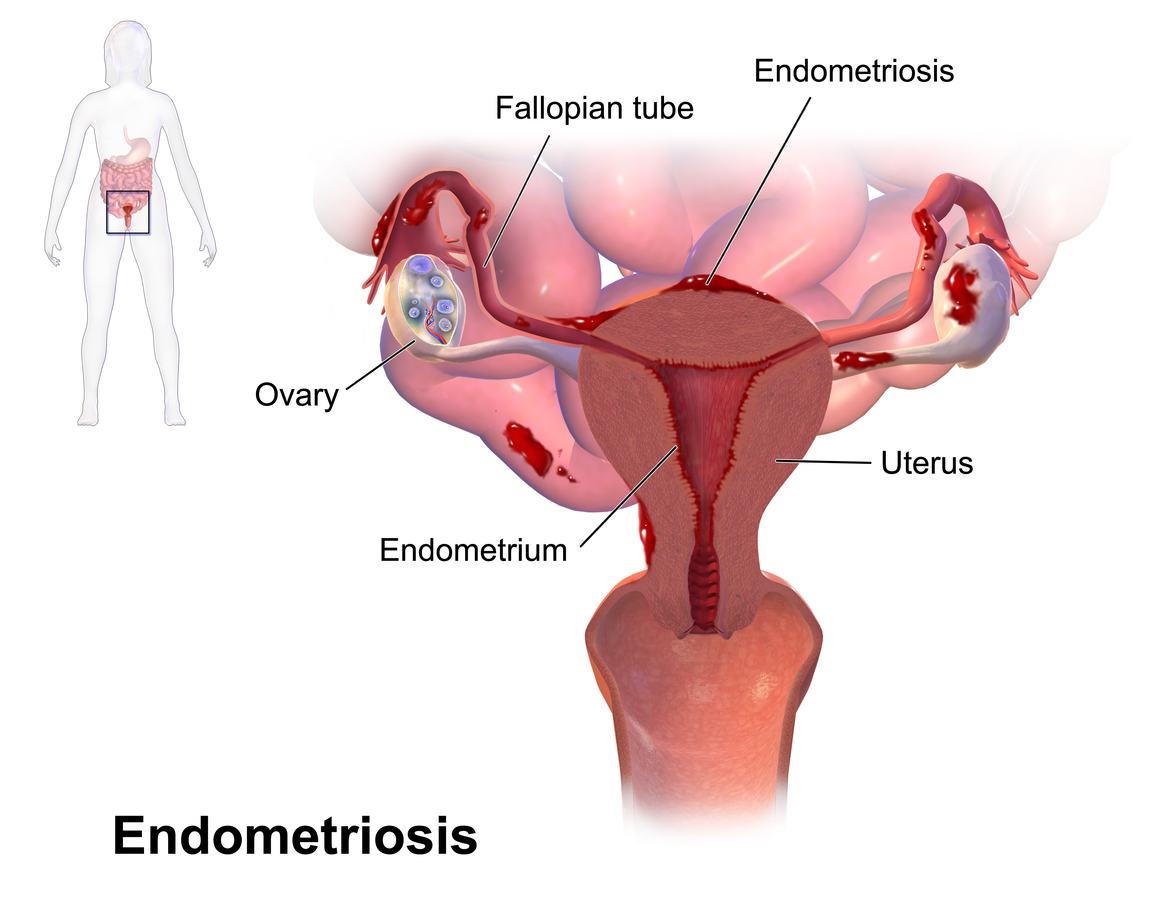 An illustration of a female human womb with endometriosis