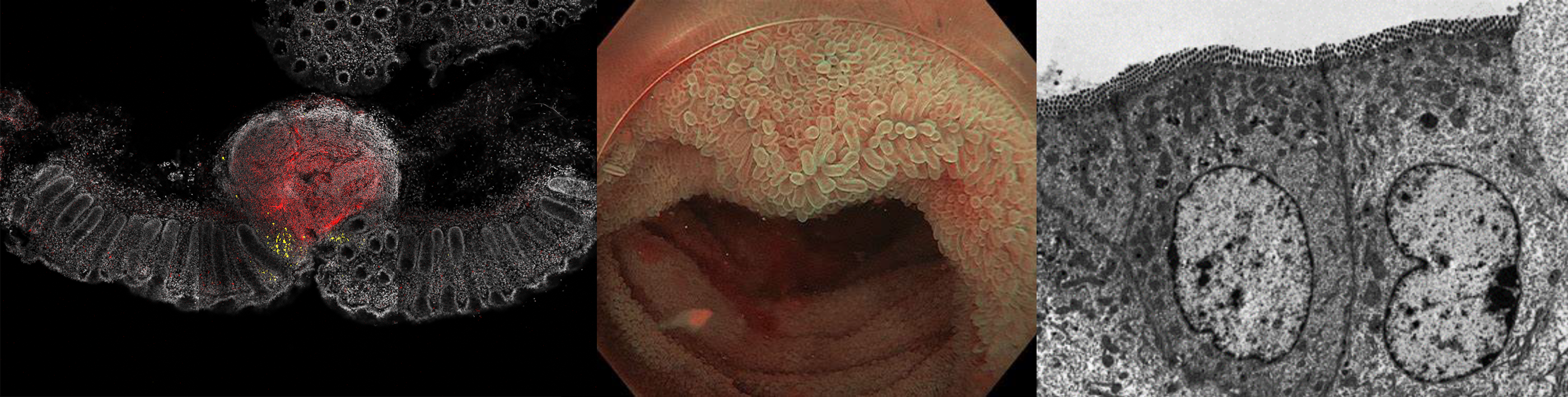 Pathology images of the gut wall